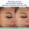 imageCetaphil Acne Face Wash Gentle Clear Clarifying Acne Cream Cleanser with 2 Salicylic Acid Deep Cleans ampamp Treats Acne Prone Skin Skin Care for Sensitive Skin 42ozNEW  42oz